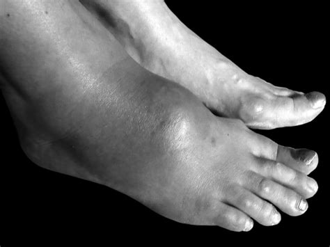 Ball Of Foot Pain Swollen Ankle at Jamie Spinelli blog