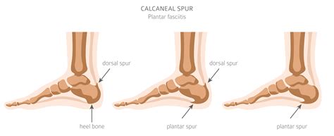Plantar Heel Spur Surgery at Henry Lymburner blog