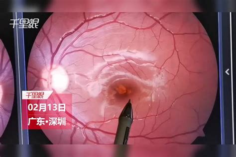 【深圳】9岁孩子视力突然降至0.5，医生；激光笔照射损坏导致视网膜病变_视网膜_医生_视力