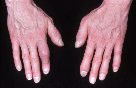 Psoriatic Arthritis And Biologics at Chuck Miranda blog