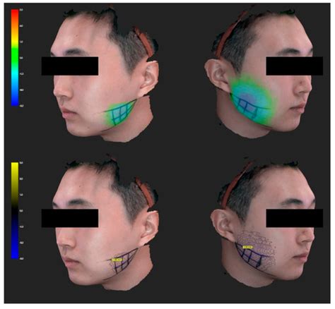 Comparison between Conventional Blind Injections and Ultrasound-Guided ...