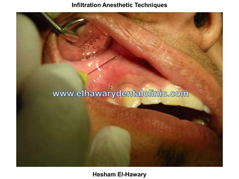 Infiltration Anesthesia Dental Lower 的图像结果