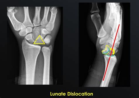 Image result for Lunate Dislocation Reduction
