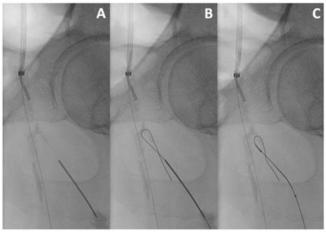 Percutaneous Endovascular Reconstruction of the Common Femoral Artery ...