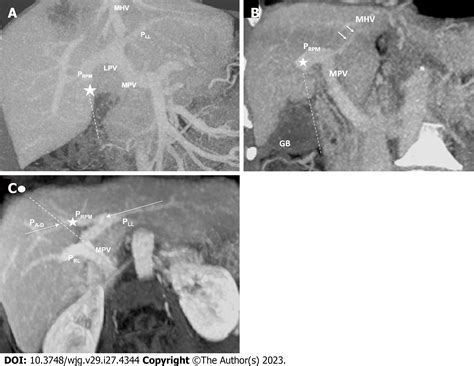 Ligamentum Teres Hepatis