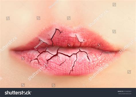 Severely Chapped Lips