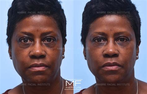 Under Eye Bags & Dark Circles Before and After Pictures Case 553 | San Francisco, CA | Mabrie ...