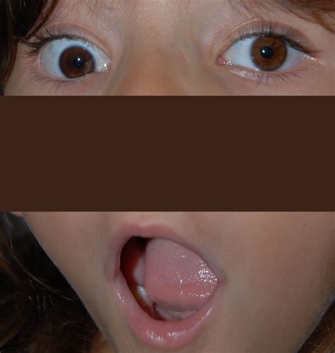 Marcus-Gunn Jaw Winking. EyeRounds.org - Ophthalmology - The University of Iowa