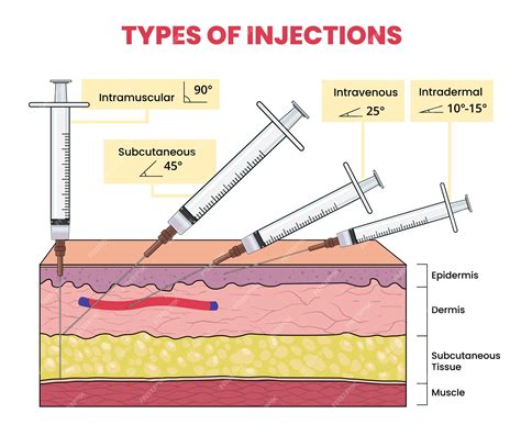 Iv Injection Types – Types Of Injections – SKRW