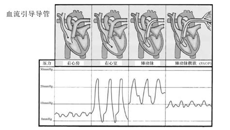 5.Swan-Ganz导管波形-特种医学-医学