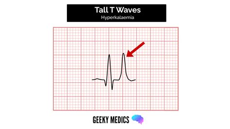 What Is Considered A Tall T Wave at Monique Wilkerson blog