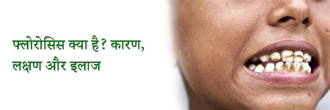 फ्लोरोसिस क्या है? कारण, लक्षण औरी इलाज | What is Fluorosis in Hindi