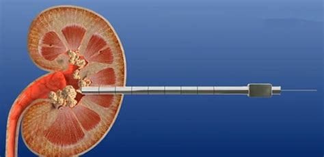 经皮肾镜-----肾脏结石治疗的大杀器 - 微医（挂号网）