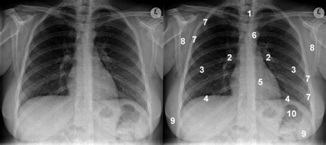 Image result for Chest X-Ray Tutorial