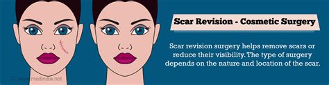 Scar Revision Procedure 的图像结果
