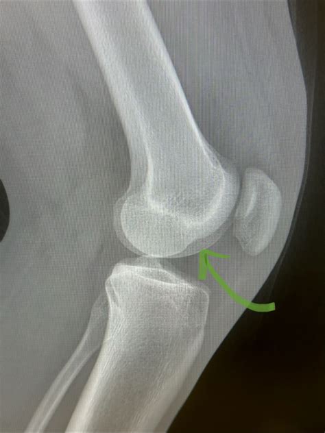 Image result for Sulcus Sign Lateral View