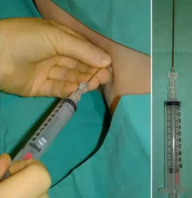 Liver Biopsy - Top 3 Gastroenterologist in Ghaziabad & Noida