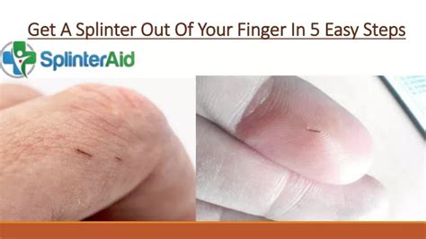 Image result for Getting Splinter Out