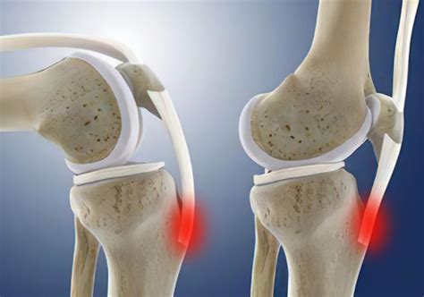 胫骨粗隆 的图像结果