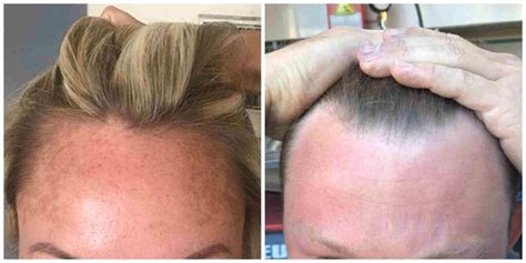 You're Not the Only One Dealing With Hair Thinning at the Temples—Experts Explain Why It's So Common
