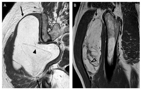Differentiation of Atypical Lipomatous Tumors from Lipomas: Our ...