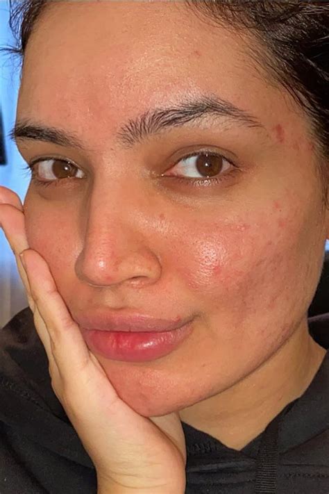 Model and activist Kadeeja Khan on acne, beauty and self-love | Vogue India