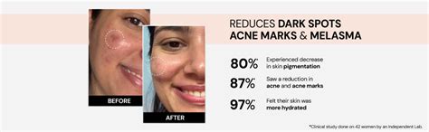 Suganda Advanced Pigmentation Face Serum | Fades Dark Spots, Melasma ...