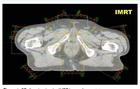 Prostate Radiation Simulation 的图像结果