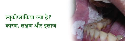 ल्यूकोप्लाकिया क्या है? कारण, लक्षण और इलाज | What is Leukoplakia in Hindi