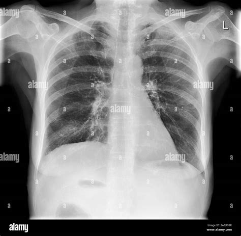 Calcified tissues. X-ray of the chest of a 72 year old female showing ...