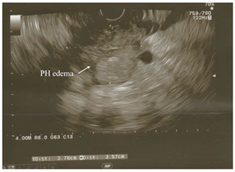 Diagnosis and Treatment of Acute Pancreatitis