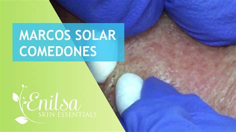 Image result for Solar Comedones Extraction