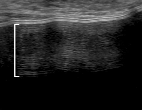 Multimodality Imaging-based Evaluation of Single-Lumen Silicone Breast Implants for ...