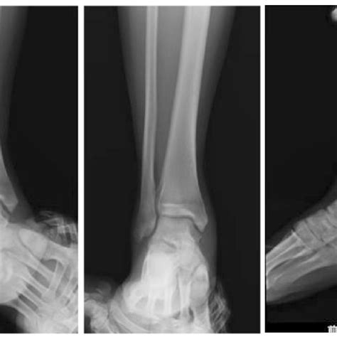 The varus and valgus stress views and anterior drawer view in X-ray 4 ...