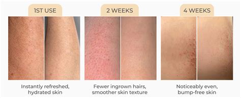 Bye bye bumps - Exfoliating Mist For ingrowns, keratosis pilaris, bumps ...