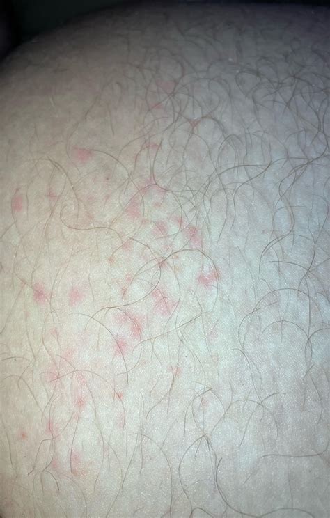 Inner thigh rash : r/DermatologyQuestions