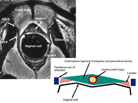 Urethral Diverticulum