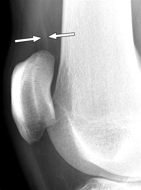 Chondromalacia Patella With Joint Effusion at Martin Goddard blog