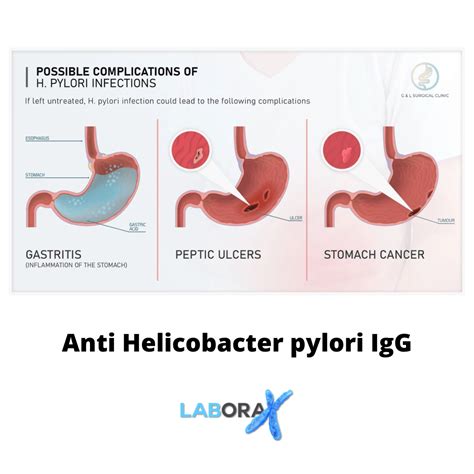 Helicobacter Pylori Antigen Not Detected Potentially Abnormal at Tracy Cline blog