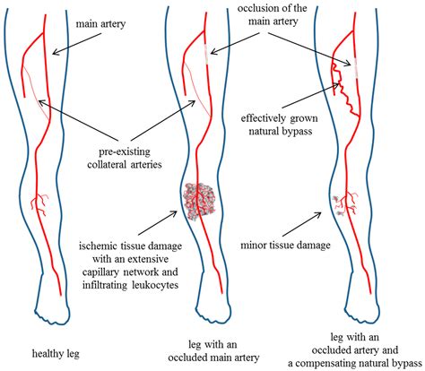 Collateral Circulation Lower Extremity