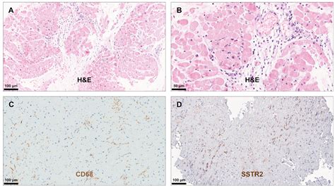 Histopathological Evaluation of Somatostatin Receptor 2 Expression in ...