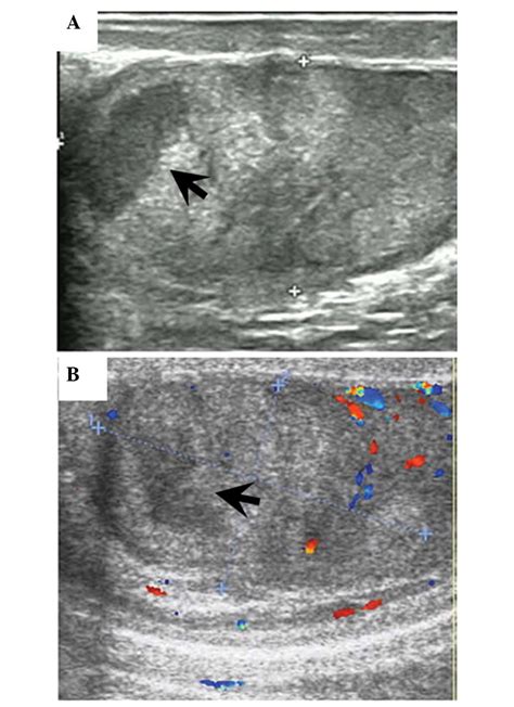 Segmental testicular infarction: A case report