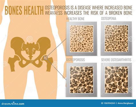 Osteoporosis Bones Poster stock vector. Illustration of health - 106994265