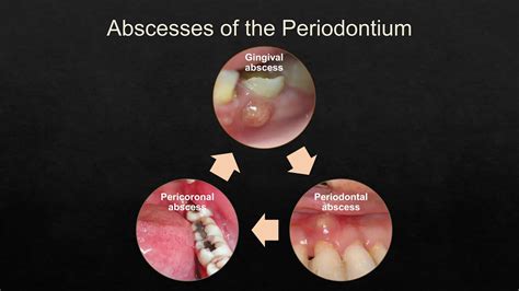 Image result for Classification Periodontitis