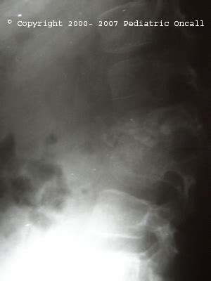 Vertebral Collapse Or Compression Fracture Of Vertebra | Spot Diagnosis ...
