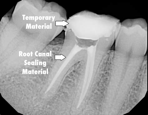 Porcelain Crowns Xray