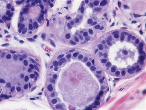 What Is Columnar Cell Change In The Breast at Holly Brough blog