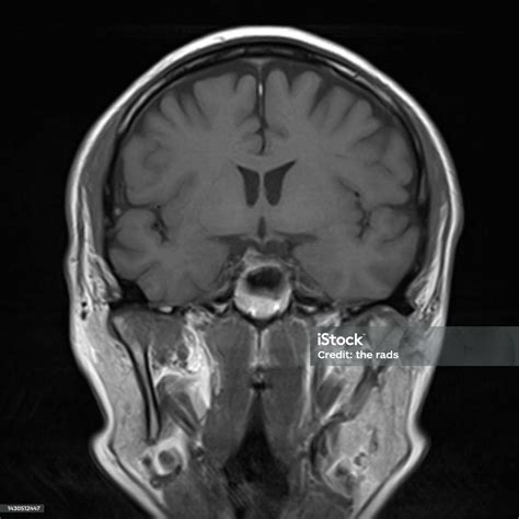 Normal Brain Mri Images Stock Photo - Download Image Now - Anatomy, Black And White, Brain Stem ...
