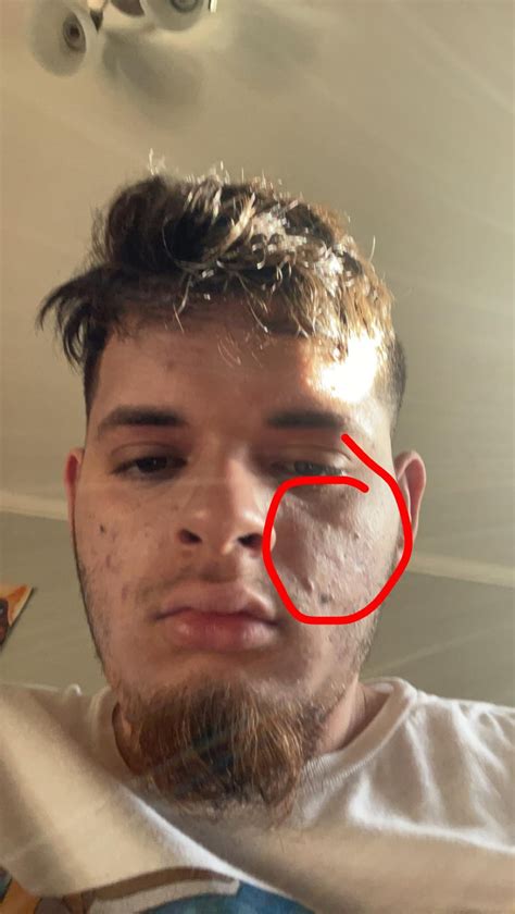 Why does one side of my face look like this anyone know how to remove it ?? : r/DermatologyQuestions
