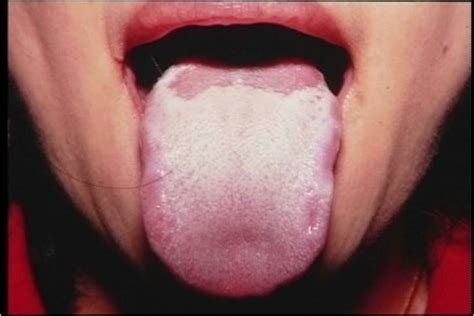 漢方シリーズ（13）：舌シリーズ 舌白苔＝消化機能低下、気の不足 | 医療ナンデモ情報局